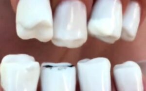 Nagels die op tanden lijken